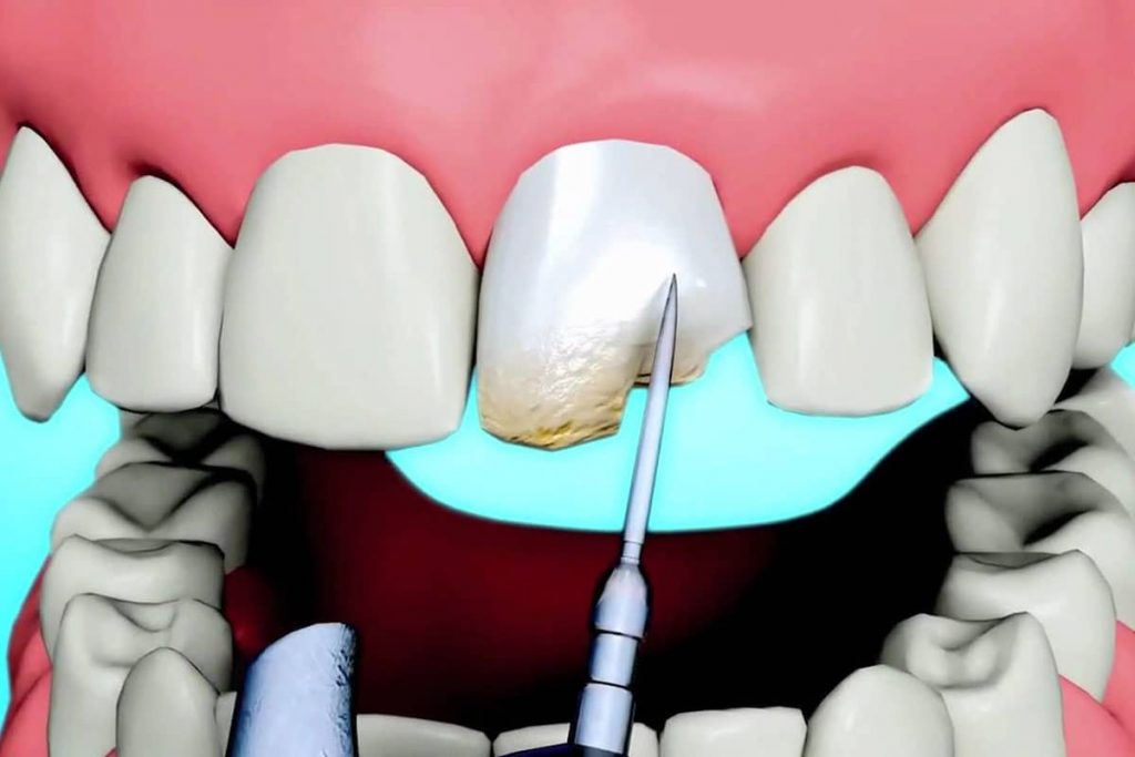 Bonding Nedir? Bonding Nasıl Yapılır?